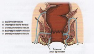 Abscesso E F Stula Anal Dr Esdras Zanoni